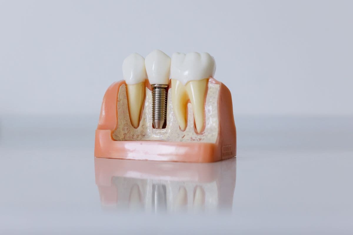 Exploring Advanced Strategies for the Effective Replacement of Missing Teeth
